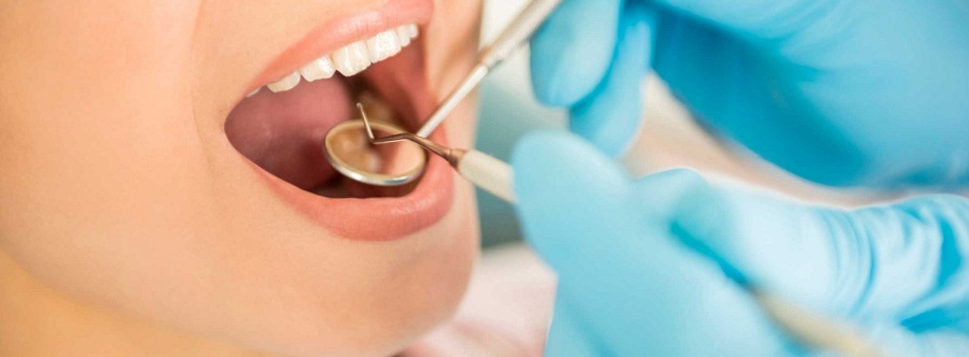 Enamel Microabrasion of Wayzata Dental Successfully Removes Dental Stains