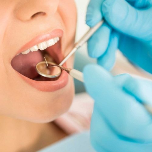Enamel Microabrasion of Wayzata Dental Successfully Removes Dental Stains